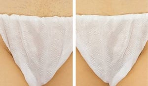 <h2>Efekty przed i po depilacji laserowej</h2>